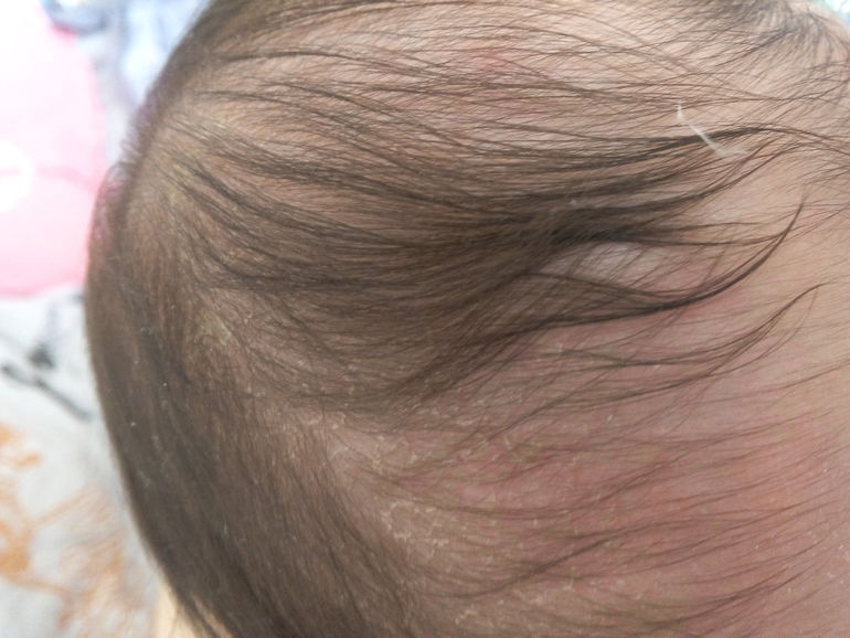 Лечение шелушения кожи головы у ребенка