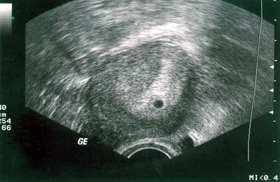 3 неделя беременности от зачатия
