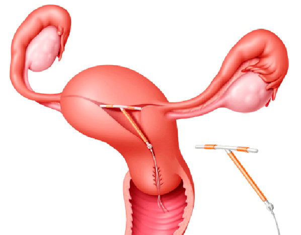 Перевязка маточных труб у женщин